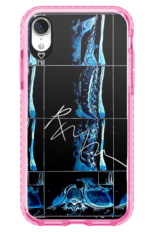 RMN Scolioza 2.0 - Apple iPhone XR