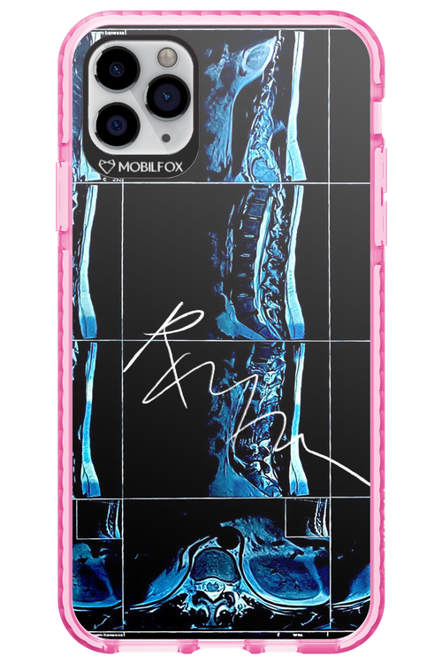 RMN Scolioza 2.0 - Apple iPhone 11 Pro Max