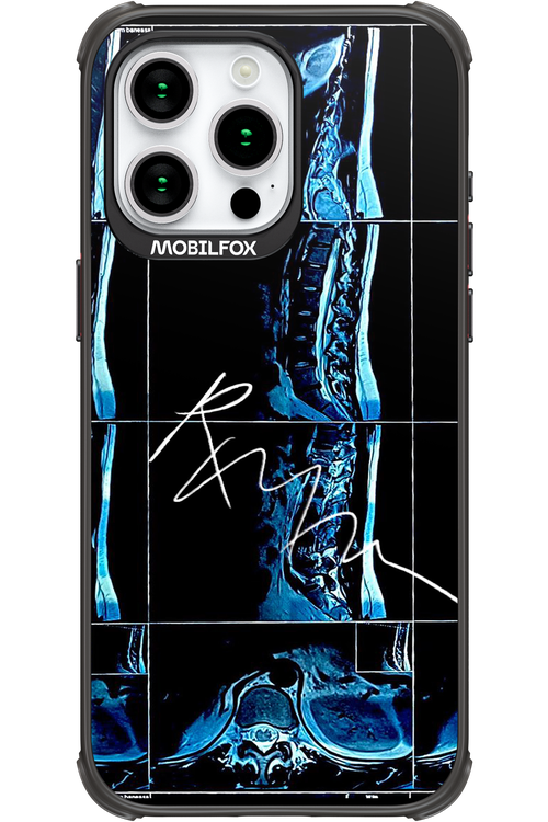 RMN Scolioza - Apple iPhone 15 Pro Max