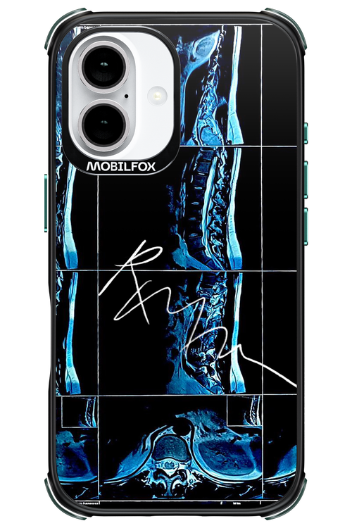 RMN Scolioza 2.0 - Apple iPhone 16