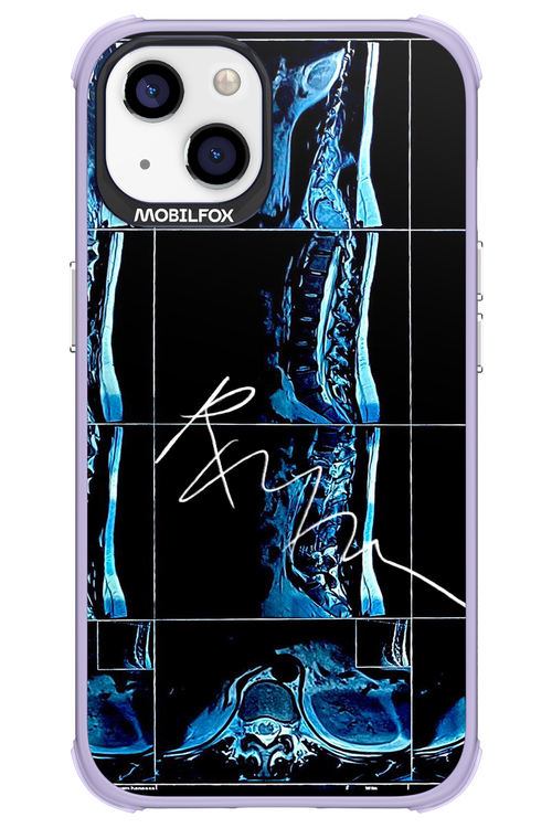 RMN Scolioza 2.0 - Apple iPhone 13
