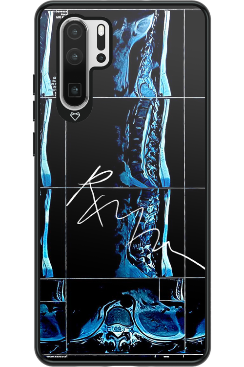 RMN Scolioza 2.0 - Huawei P30 Pro
