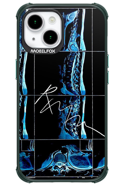 RMN Scolioza 2.0 - Apple iPhone 15