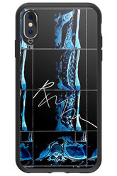 RMN Scolioza 2.0 - Apple iPhone XS Max
