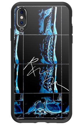 RMN Scolioza 2.0 - Apple iPhone XS Max