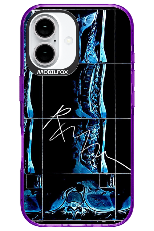 RMN Scolioza 2.0 - Apple iPhone 16