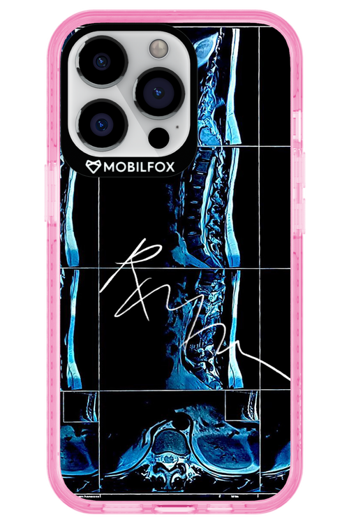RMN Scolioza 2.0 - Apple iPhone 13 Pro