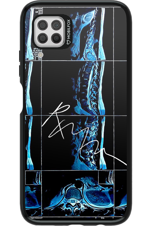 RMN Scolioza 2.0 - Huawei P40 Lite