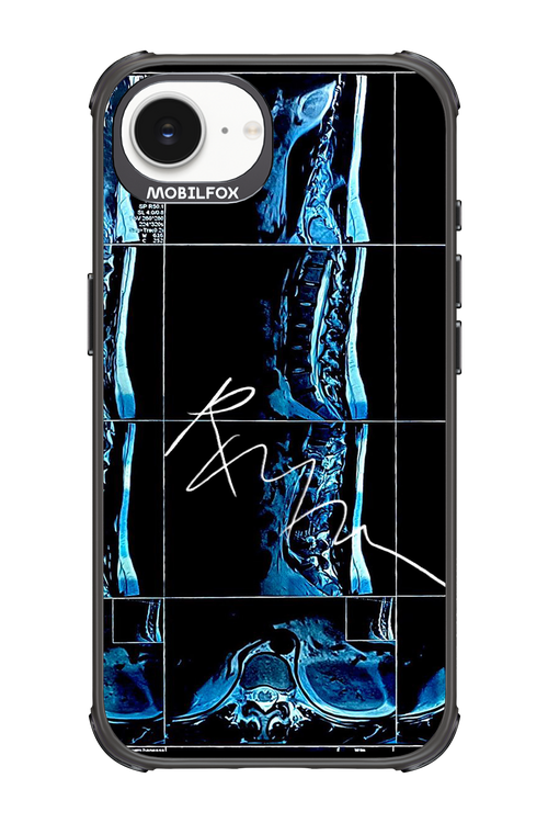 RMN Scolioza 2.0 - Apple iPhone 16e