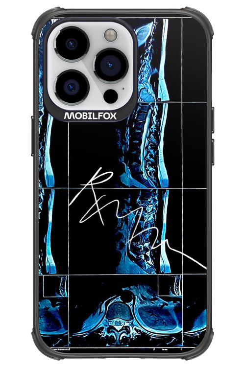 RMN Scolioza 2.0 - Apple iPhone 13 Pro
