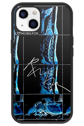 RMN Scolioza 2.0 - Apple iPhone 13