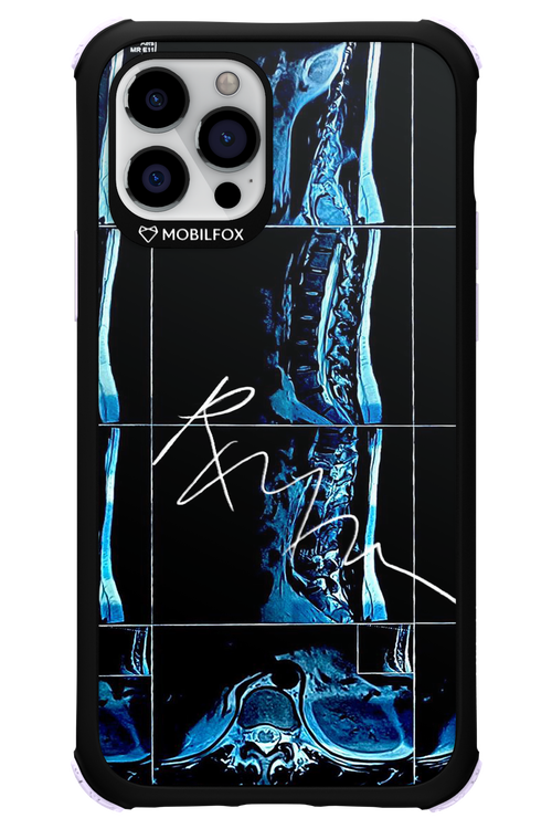 RMN Scolioza 2.0 - Apple iPhone 12 Pro