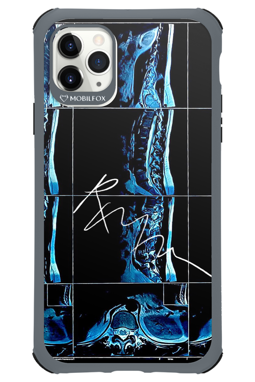 RMN Scolioza 2.0 - Apple iPhone 11 Pro Max