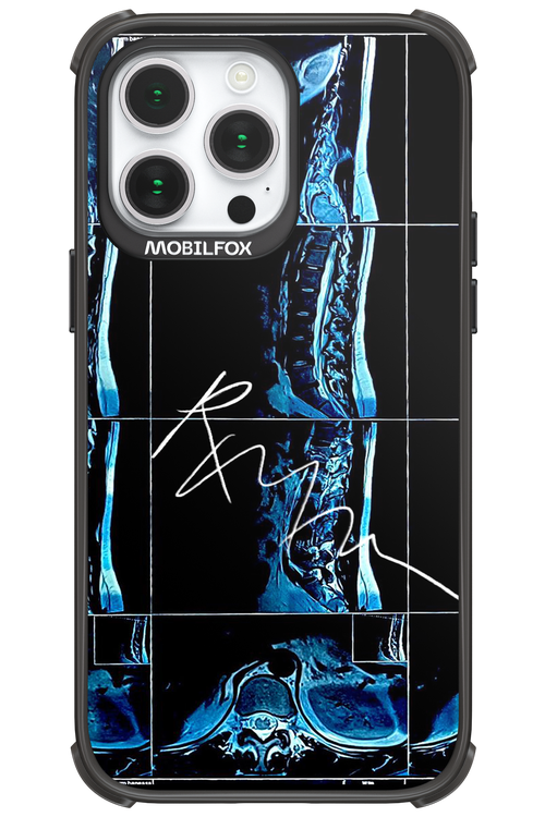RMN Scolioza 2.0 - Apple iPhone 14 Pro Max