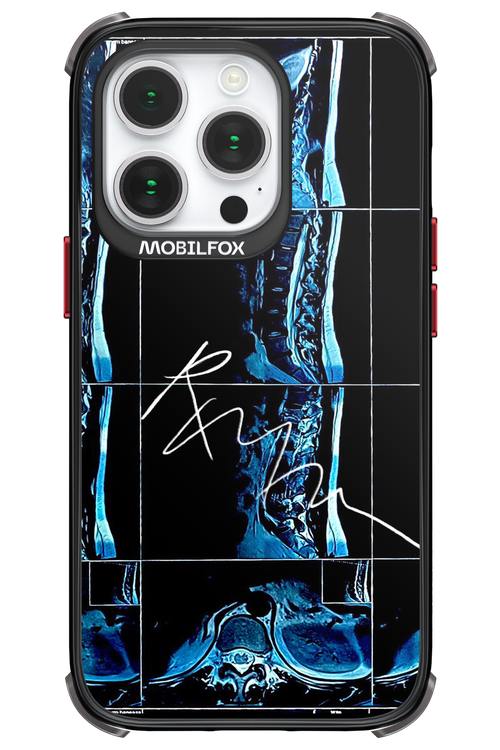 RMN Scolioza 2.0 - Apple iPhone 14 Pro