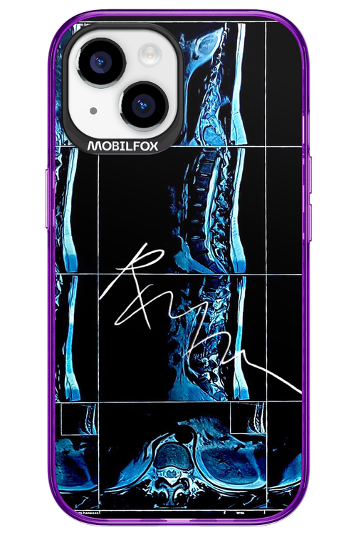 RMN Scolioza 2.0 - Apple iPhone 15