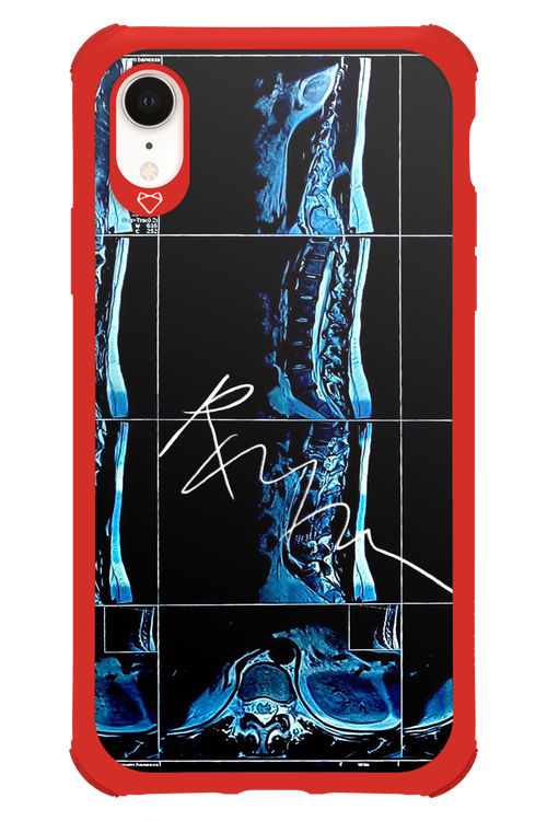 RMN Scolioza 2.0 - Apple iPhone XR