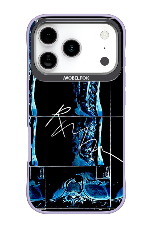 RMN Scolioza 2.0 - Apple iPhone 17 Pro