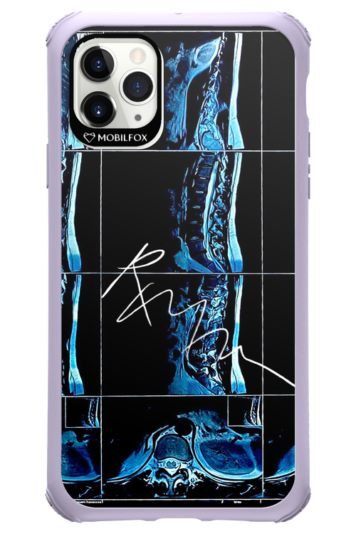 RMN Scolioza 2.0 - Apple iPhone 11 Pro Max