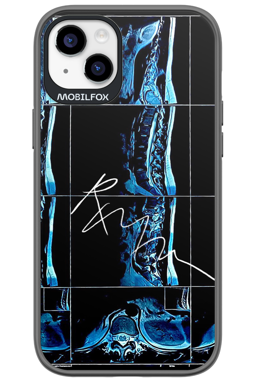 RMN Scolioza 2.0 - Apple iPhone 14 Plus