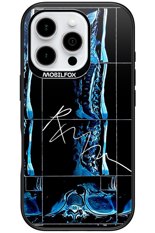 RMN Scolioza - Apple iPhone 16 Pro