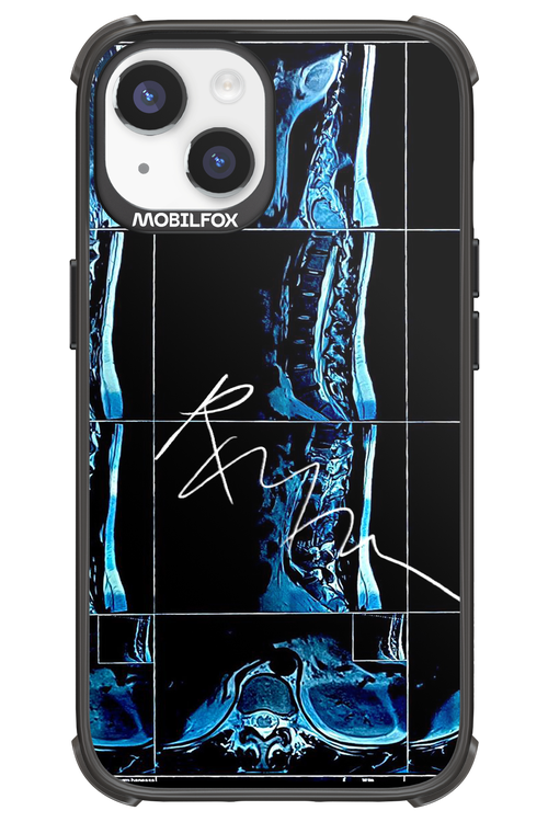RMN Scolioza 2.0 - Apple iPhone 14