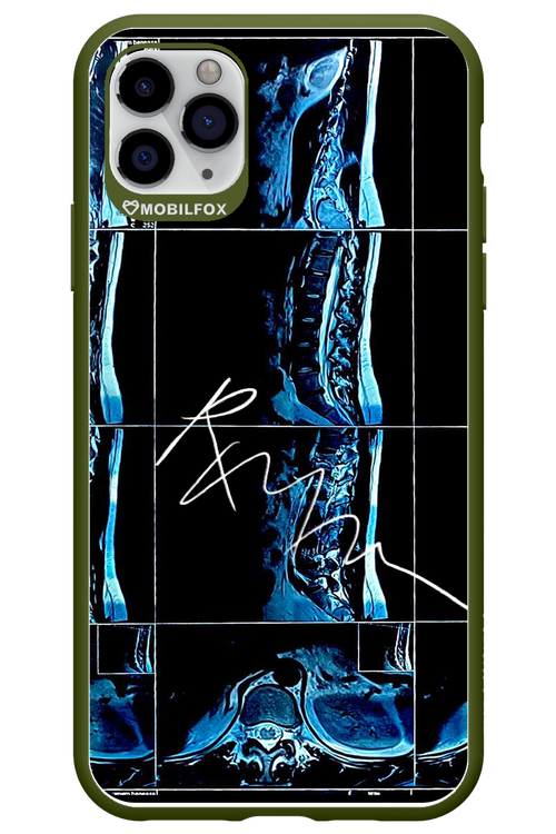 RMN Scolioza 2.0 - Apple iPhone 11 Pro Max