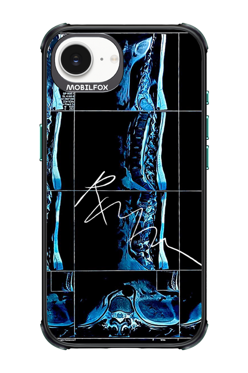 RMN Scolioza 2.0 - Apple iPhone 17e