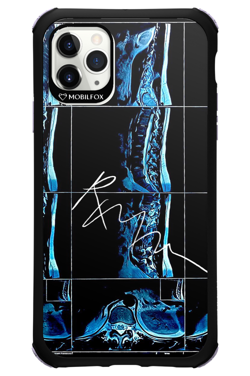 RMN Scolioza 2.0 - Apple iPhone 11 Pro Max