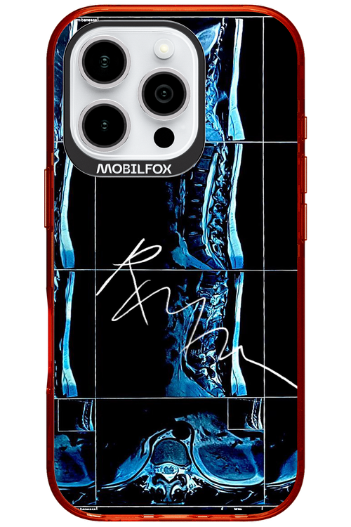 RMN Scolioza 2.0 - Apple iPhone 16 Pro