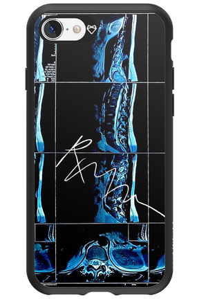 RMN Scolioza 2.0 - Apple iPhone SE 2020