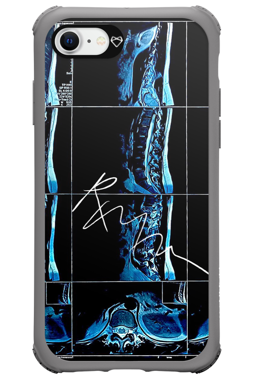 RMN Scolioza 2.0 - Apple iPhone SE 2020
