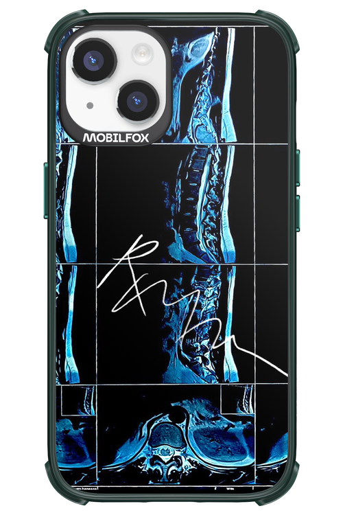 RMN Scolioza 2.0 - Apple iPhone 14