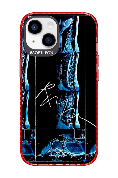 RMN Scolioza 2.0 - Apple iPhone 14