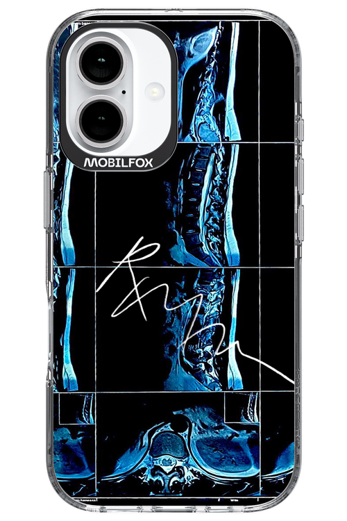 RMN Scolioza 2.0 - Apple iPhone 16