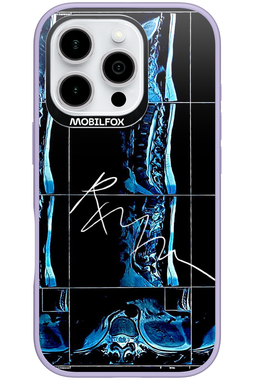 RMN Scolioza - Apple iPhone 16 Pro