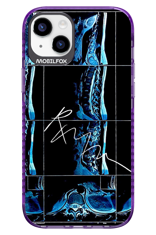 RMN Scolioza 2.0 - Apple iPhone 14 Plus