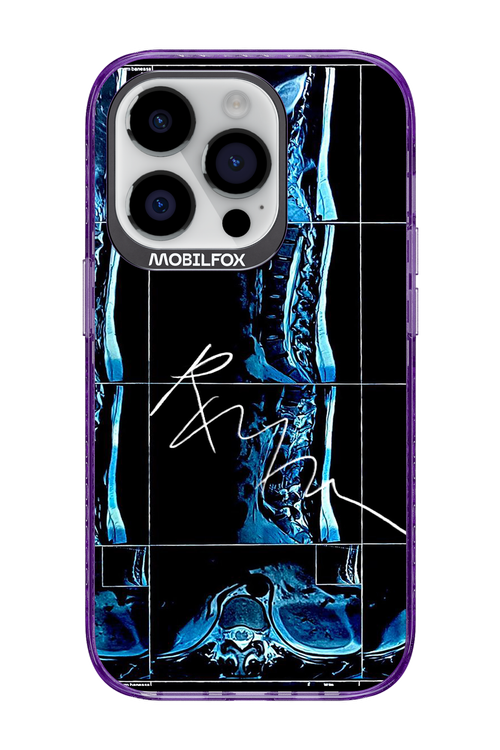 RMN Scolioza 2.0 - Apple iPhone 14 Pro