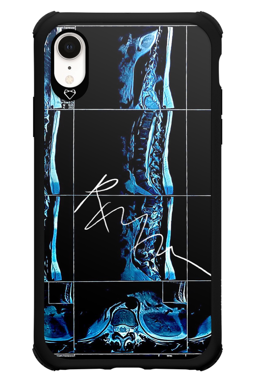 RMN Scolioza 2.0 - Apple iPhone XR