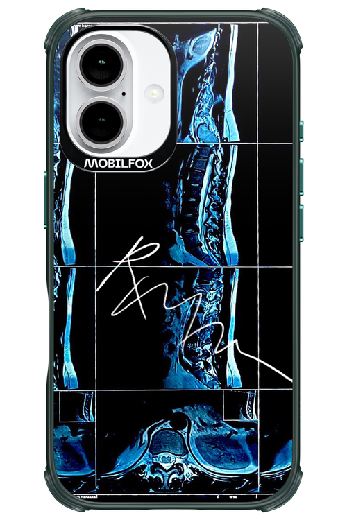RMN Scolioza 2.0 - Apple iPhone 16