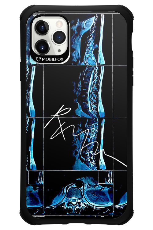 RMN Scolioza 2.0 - Apple iPhone 11 Pro Max
