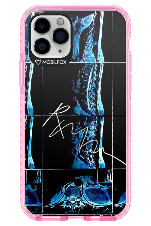 RMN Scolioza 2.0 - Apple iPhone 11 Pro