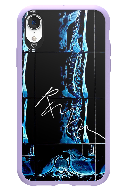 RMN Scolioza 2.0 - Apple iPhone XR