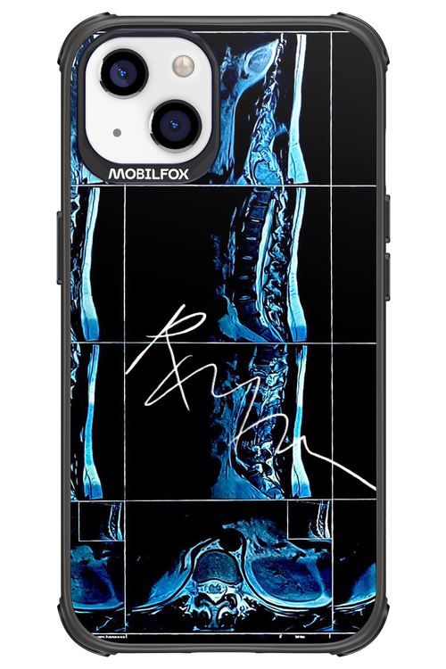 RMN Scolioza 2.0 - Apple iPhone 13