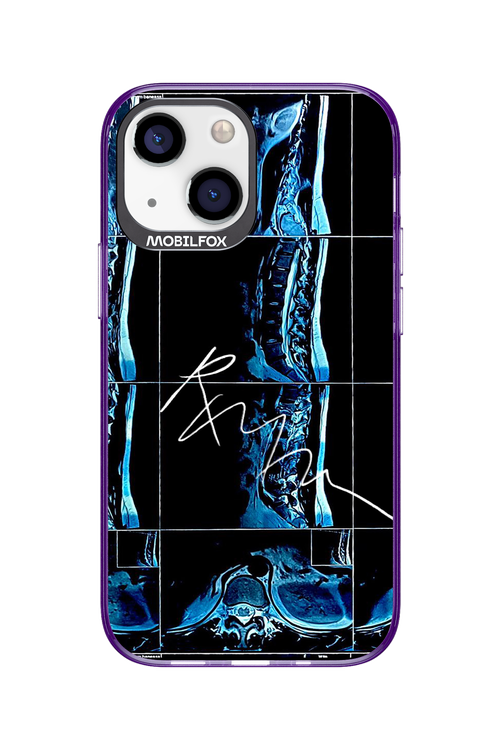 RMN Scolioza 2.0 - Apple iPhone 13 Mini