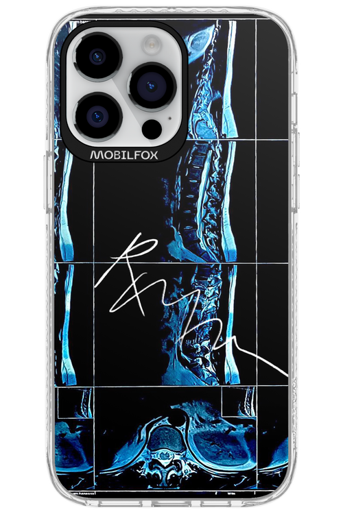 RMN Scolioza 2.0 - Apple iPhone 14 Pro Max