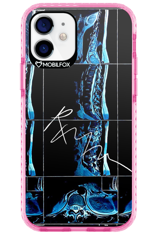 RMN Scolioza 2.0 - Apple iPhone 12