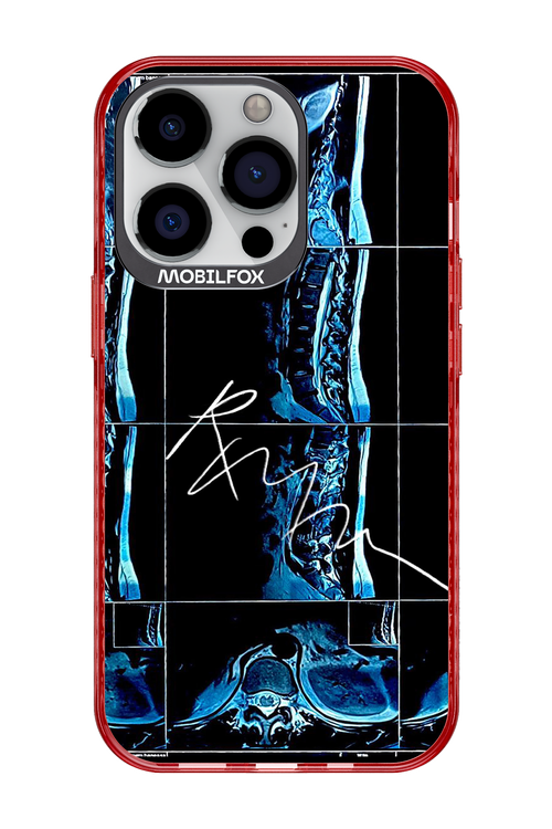 RMN Scolioza 2.0 - Apple iPhone 13 Pro