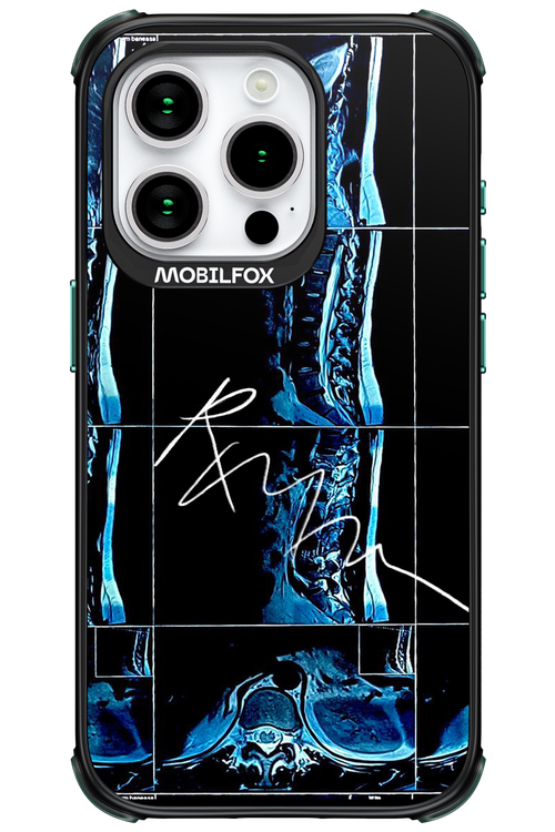 RMN Scolioza - Apple iPhone 15 Pro