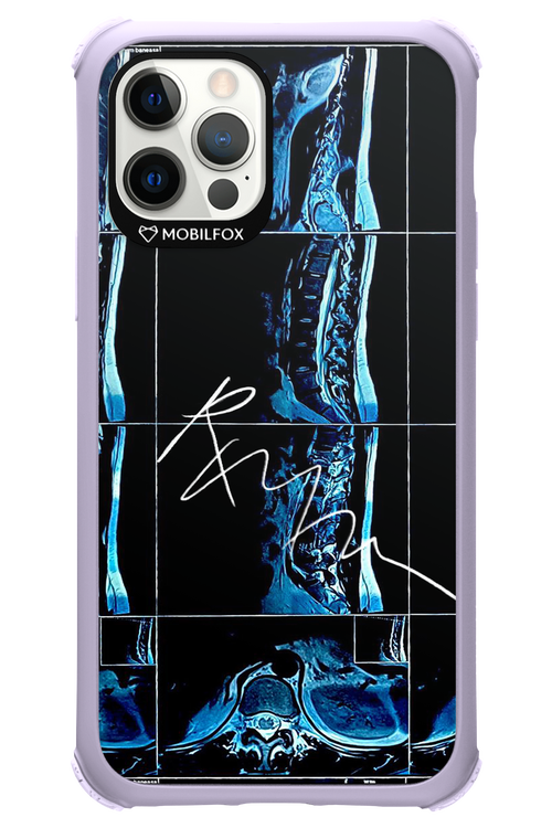 RMN Scolioza 2.0 - Apple iPhone 12 Pro